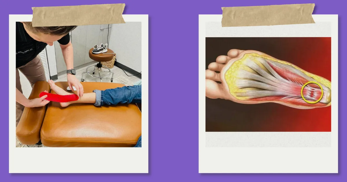 Photo collage of foot treatment and an illustration of plantar fascia heel pain